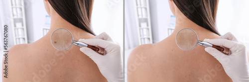 Mole removal. Collage with photos of patient's back before and after procedure, closeup. Dermatologist looking at skin through magnifying glass