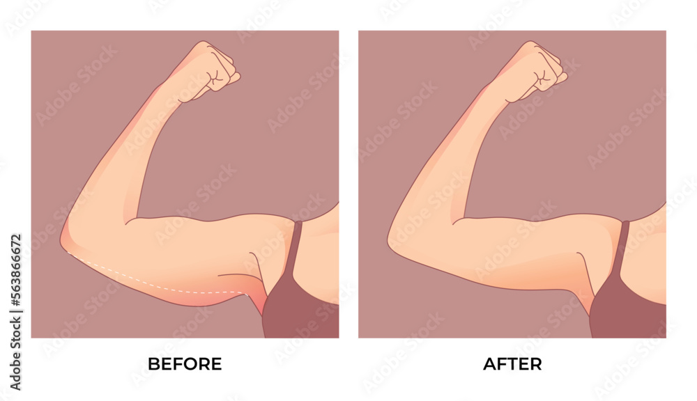 Upper Arm Fat Before And After Brachioplasty Liposuction Or Plastic upper-arm-fat-before-and-after-brachioplasty-liposuction-or-plastic
