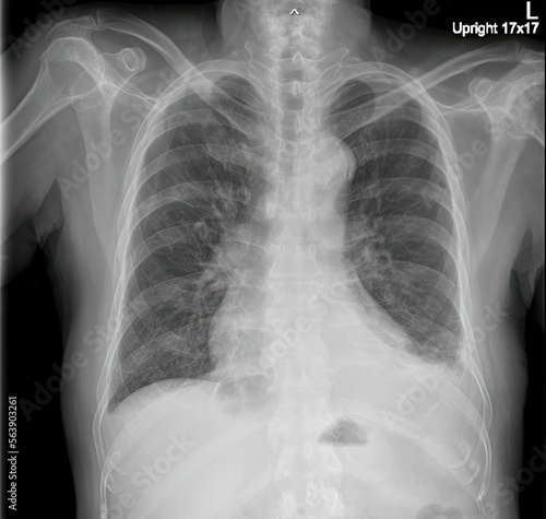 chest x-ray showing enlargement of the heart or cardiomegaly.