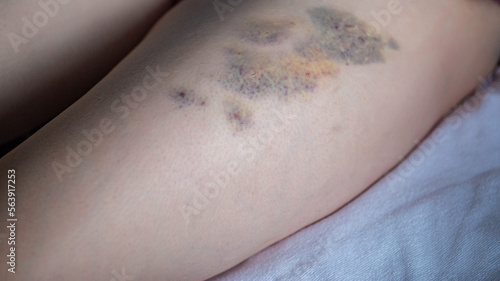 Bruises on the skin of the patient s leg after intramuscular injections of the drug. Treatment of seals and bruises after injections.