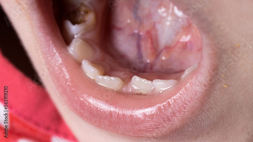 Crooked teeth in a child's mouth. The permanent tooth grows next to the milk tooth, close-up