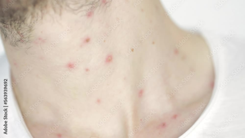 Body of adult man have spotted, red pimple and bubble rash from monkeypox or varicella zoster virus. Medical complications after illness Body of adult man have spotted, red pimple and bubble rash from monkeypox or varicella zoster virus. Medical complications after illness