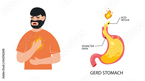 Man suffering from GERD symptom with acid reflux because of sphincter opened stomach. Gastroesophageal reflux disease. Heartburn. Digestive system disease. Flat vector illustration.