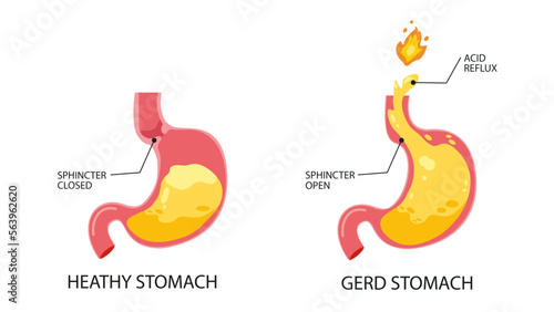 Gastroesophageal reflux disease. Infographic of normal healthy stomach and GERD stomach or heartburn. Acid moving up into the esophagus because sphincter open. Health and medicine. Flat photo