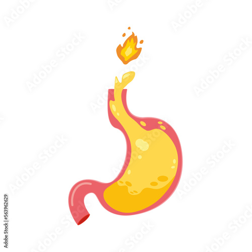 Gastroesophageal reflux disease. Sphincter open allowing acid reflux to esophagus cause of Heartburn. GERD stomach isolated on white background. Health care and medicine illustration flat vector style