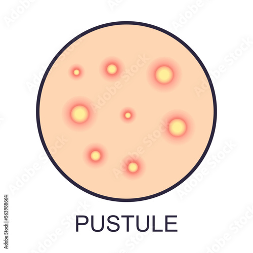 Skin pustule problems vector illustration. Sign of dry or oily skin problems isolated on white background. Health, skincare concept