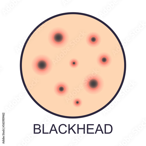 Skin blackhead problems vector illustration. Sign of dry or oily skin problems isolated on white background. Health, skincare concept