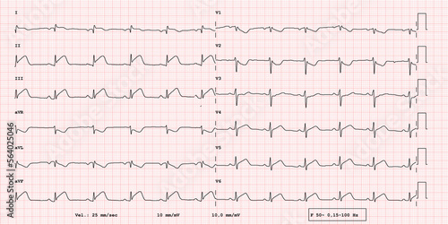 ECG example of 12-lead rhythm, acute myocardial infarction, real exam