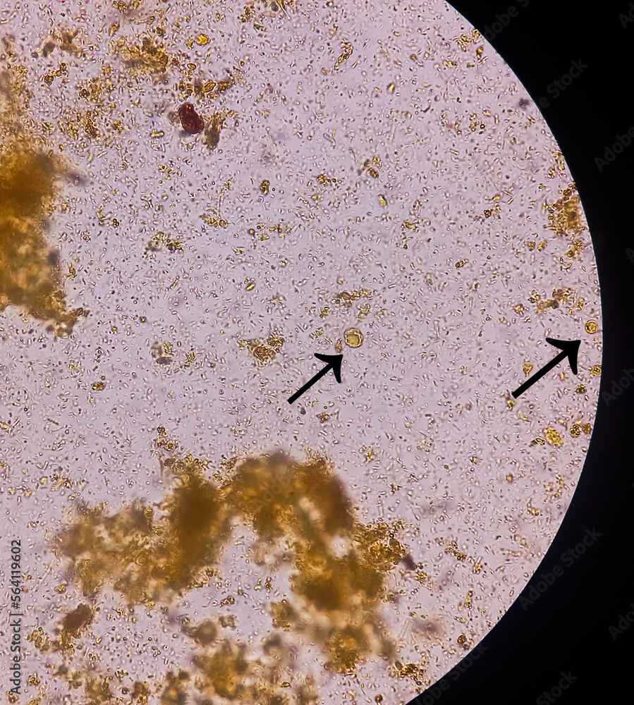Microscopic examination of Stool showing Blastocystis hominis (Vacuolar