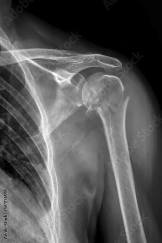 X-ray image of a broken shoulder bone, fracture neck of Humerus bone.
