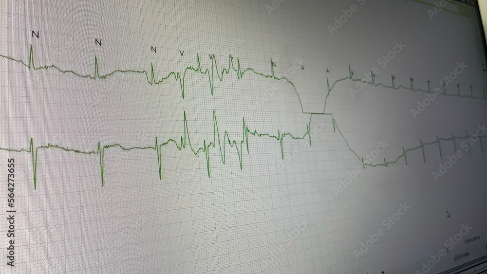 Electrocardiograph (EKG) artifacts are defined as EKG abnormalities