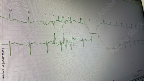 Electrocardiograph (EKG) artifacts are defined as EKG abnormalities