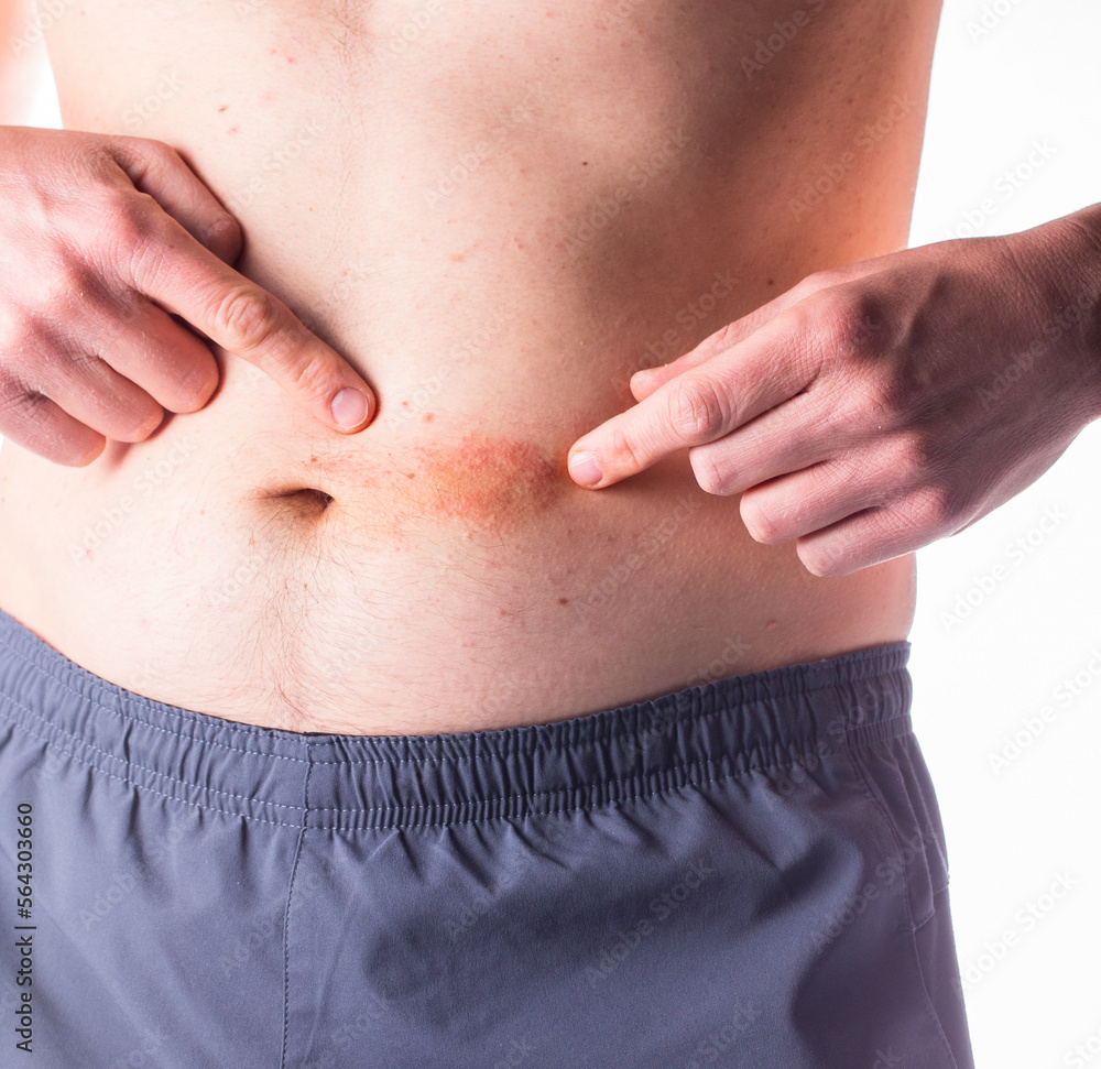 The first signs of psoriasis or another skin disease.