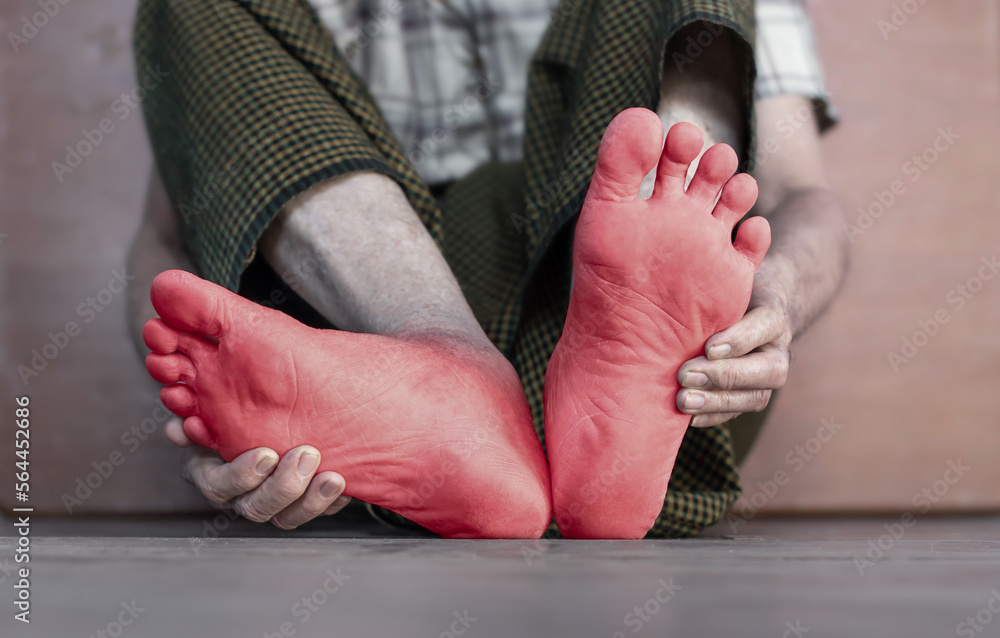 Tingling and burning sensation in foot of Asian elder man with diabetes