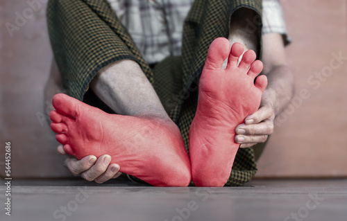 Tingling and burning sensation in foot of Asian elder man with diabetes. Foot pain. Sensory neuropathy problems. Foot nerves problems. Plantar fasciitis.