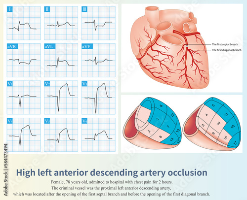 Papier peint The occlusion of the proximal left anterior descending artery can cause large area of anterior MI, and the occlusion site can be interpreted according to the ST segment elevation leads of ECG