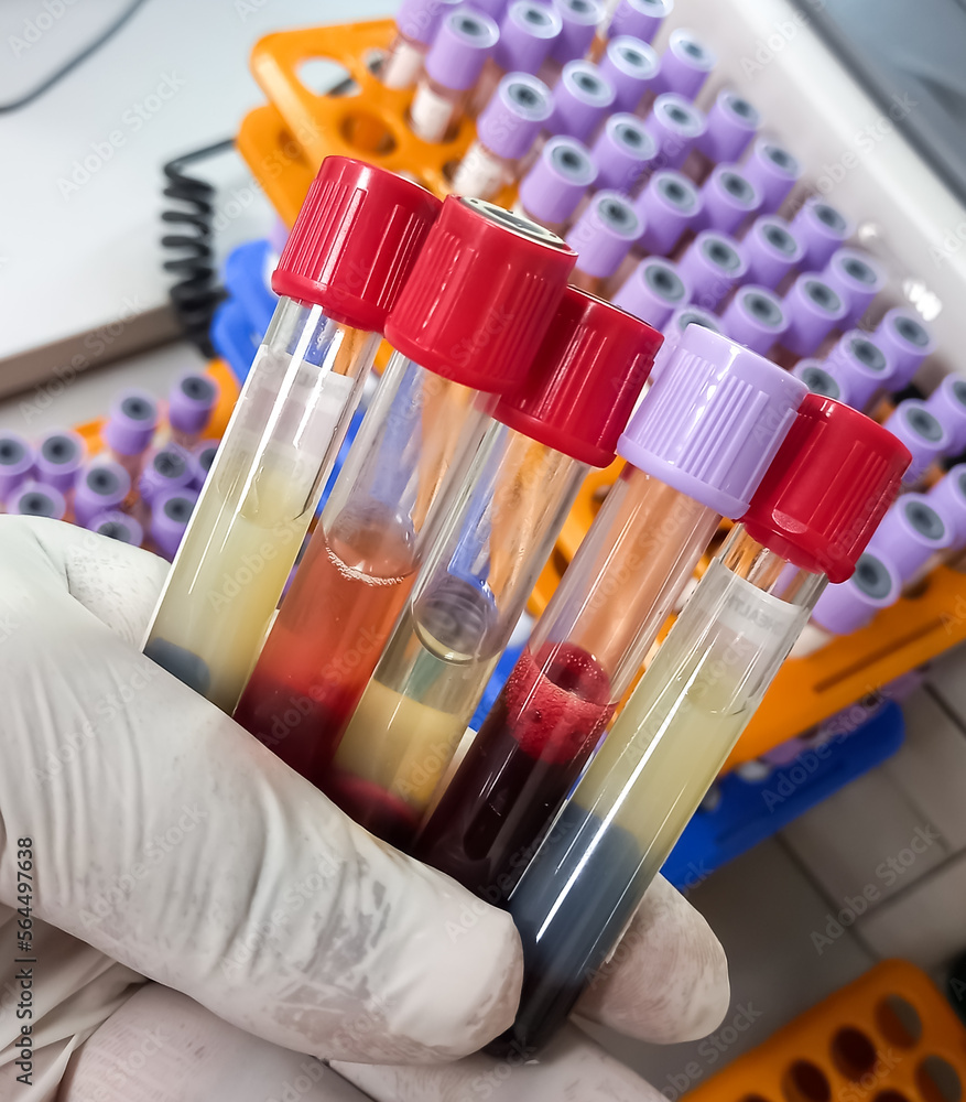 Lipemic blood sample, frees serum, whole blood, hemolyzed serum