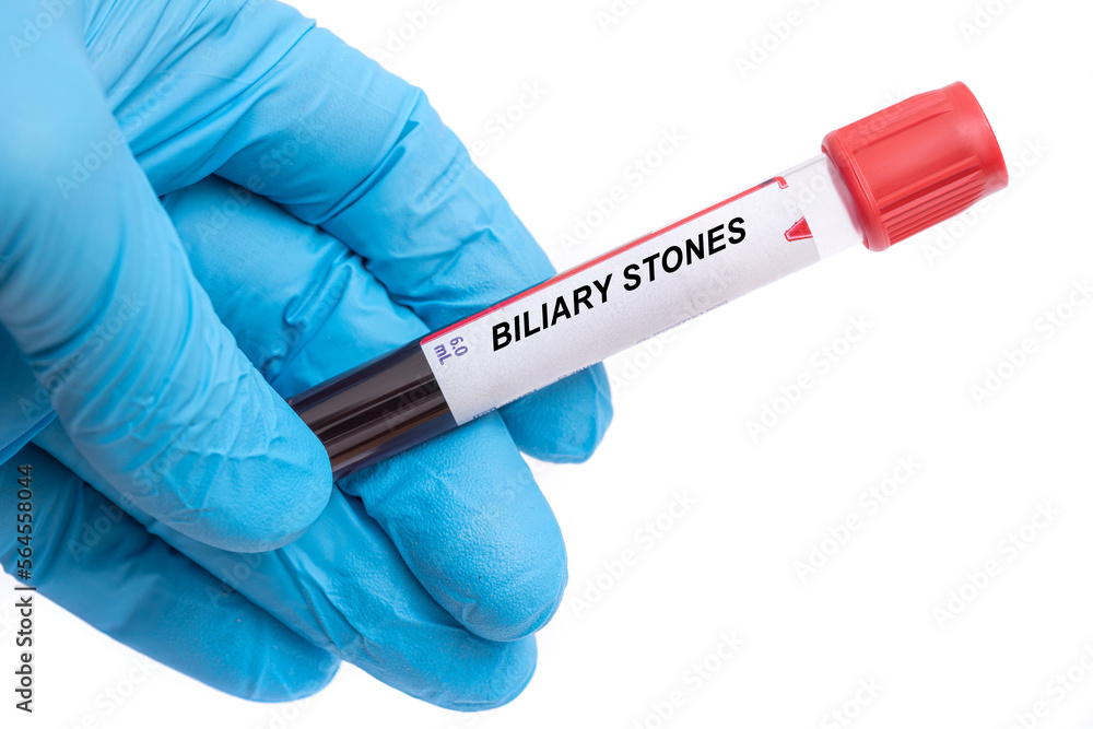 Obraz premium Biliary Stones. Biliary Stones disease blood test in doctor hand