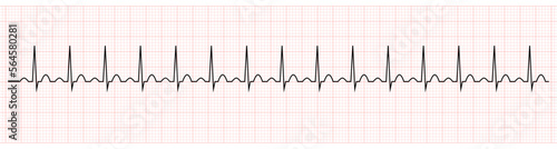 EKG Showing Sinus tachycardia of Patient 