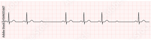 EKG Showing second degree av block mobitz II