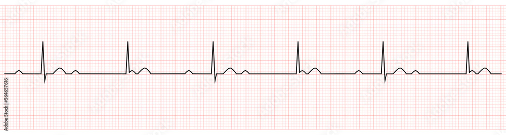 EKG Showing third degree or complete av block