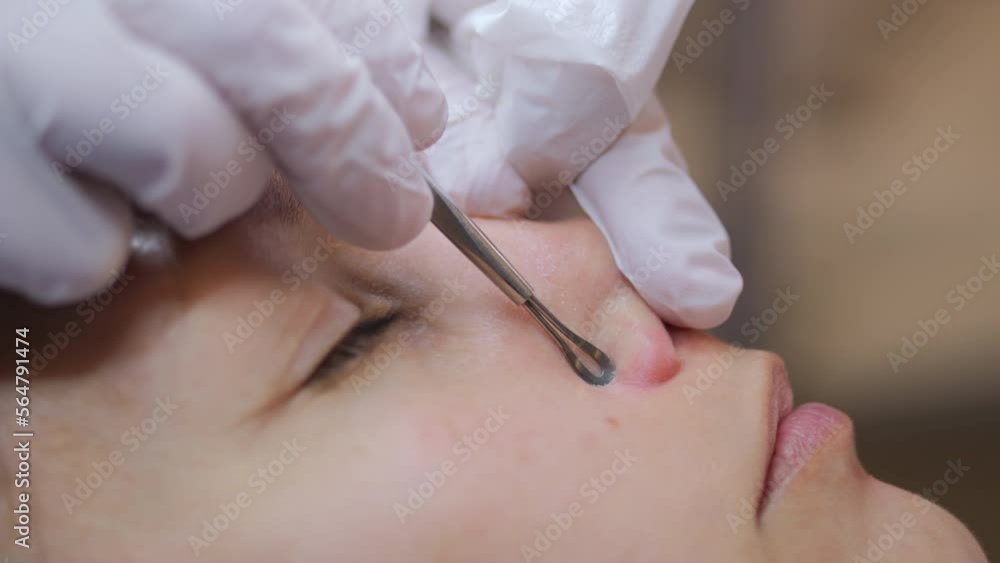 Dead skin cells on face being removed in skin therapy clinic. Macro close up, static Dead skin cells on face being removed in skin therapy clinic. Macro close up, static