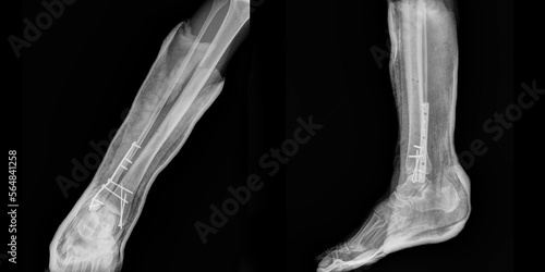 Radiography of osteosynthesis of the ankle joint