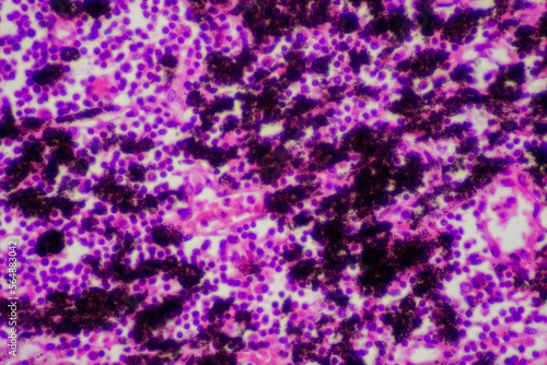 Chronic bronchitis disease human cells