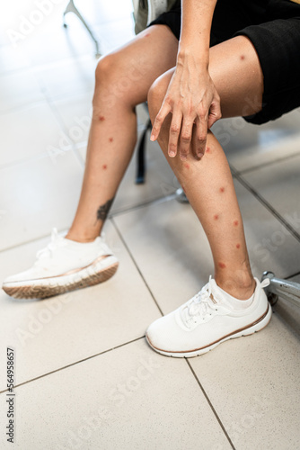woman with mosquito bites photo
