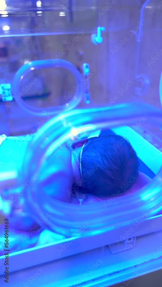 Newborn having a treatment for jaundice under ultraviolet light, Baby has high level of