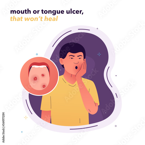 Man with painful aphthous stomatitis (canker sore) that won't heal. Medical concept of a chronic oral lesion, a symptom of an autoimmune disease or infection. For health awareness websites