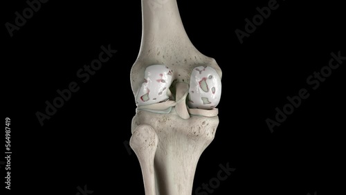 3D rendered medical animation of damaged knee cartilage photo