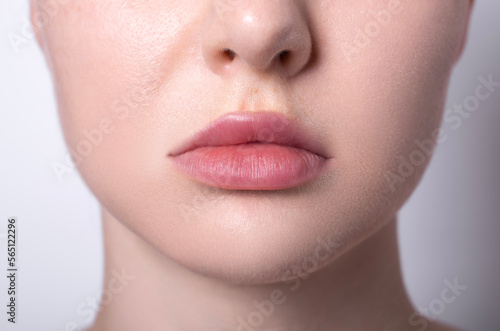 woman asymmetric lips as a result after lip augmentation with hyaluronic acid filler entered incorrectly, cosmetologist's mistake, contour lip plastic surgery