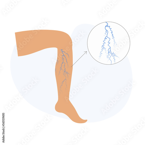 Varicose veins in the legs. Vascular or spider veins. Vector illustration. 