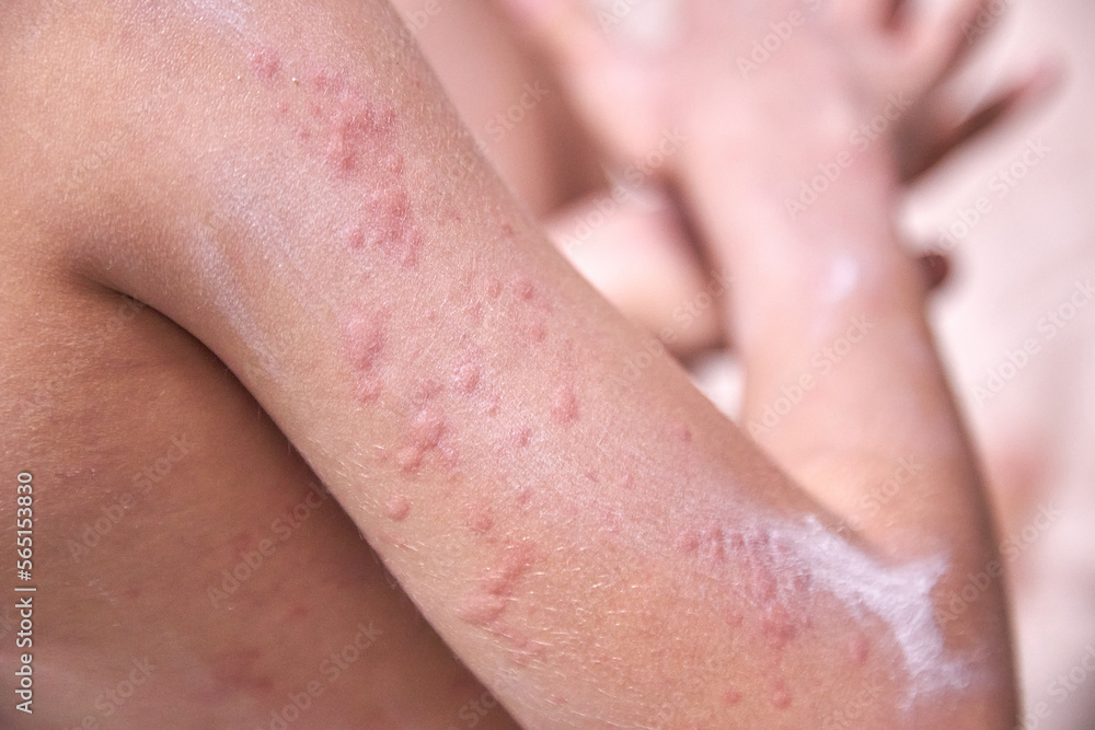 Fototapeta premium food allergy. a boy with red spots. The child has itching, with an allergic rash..