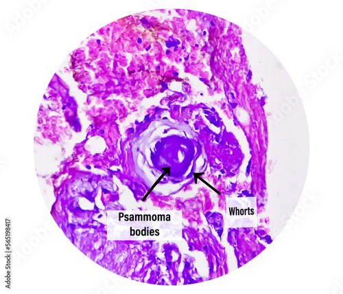 Psammoma bodies. Spinal tumor biopsy. Psammomatous meningioma. photo