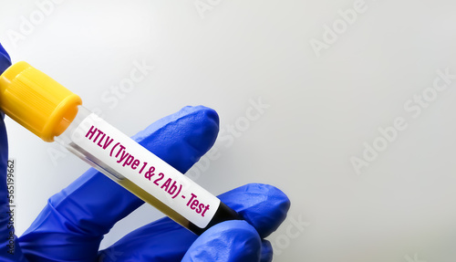 Blood sample for Human T-lymphotropic virus or Human T-cell leukemia virus or HLTV test, to diagnose a type of cancer called adult T-cell leukemia or Lymphoma. photo