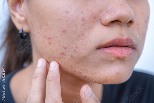 Quadro su tela Close up of young Asian woman worry about her face when she has problems with skin on her face