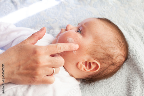 Baby with atopic dermatitis getting cream put. Care and Prevention Of Eczema.