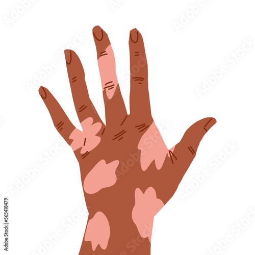 Hand back of the palm in relaxed gesture, brown skin with vitiligo patch