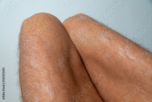 Large plaque parapsoriasis on caucasian man legs