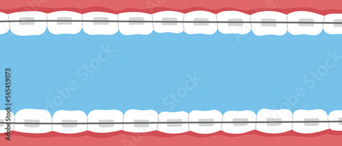 Teeth braces banner. Orthodontic problem, smile with brackets, retainer. Flat vector isolated illustration
