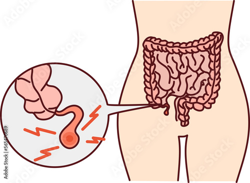 Human body with inflamed appendicitis photo