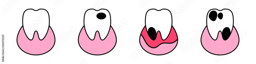 Tooth icons set. Dentist teeth. Inflammation of the gums. Tooth crumbling. Hole in the tooth. Caries. Vector illustration isolated on white background. Tooth icons set. Dentist teeth. Inflammation of the gums. Tooth crumbling. Hole in the tooth. Caries. Vector illustration isolated on white background.