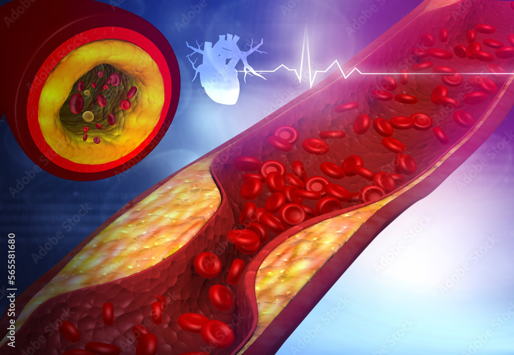 Artery blocked with bad cholesterol. clogged arteries, coronary artery plaque. 3d illustration - obrazy, fototapety, plakaty 