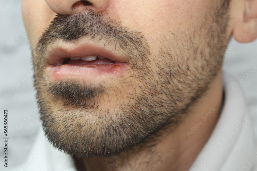 Obraz premium Herpes labials infection on the lips of a man. Close up.