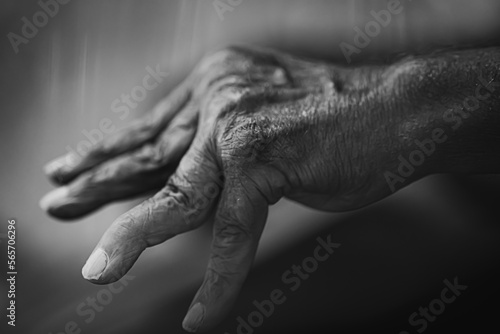 Black and White Elderly Hand with Arthritis - Finger and Wrist Joint Pain