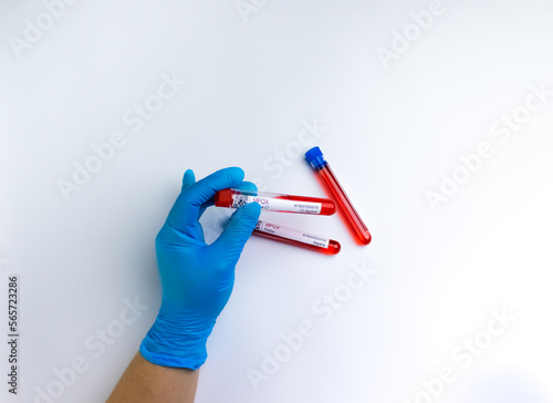 flasks with blood tests for monkey pox virus positive and negative, mpox