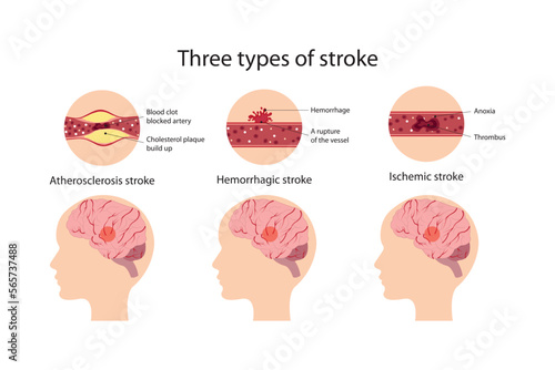 Three types of stroke. Atherosclerosis, hemorrhagic and ischemic stroke photo