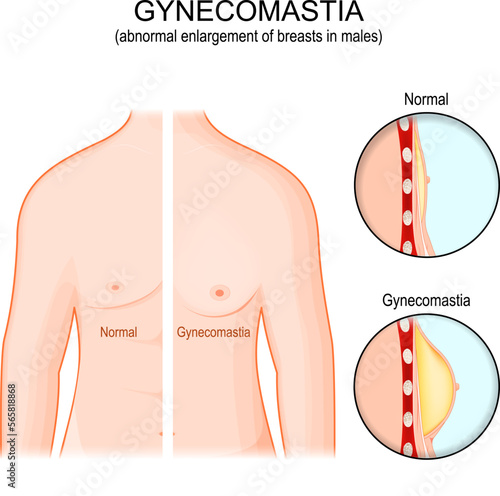 Gynecomastia. Torso of healthy man and abnormal enlargement of breasts in male